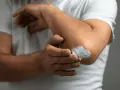 Mężczyzna smaruje łokieć kremem. Szukasz najlepszej kliniki leczenia łuszczycy?