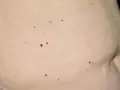 Czerwone pieprzyki na brzuchu, drobne i kilka większych, rozrzucone na jasnej skórze.