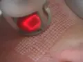 Zabieg laserem frakcyjnym: czerwony promień lasera tworzy na skórze siatkę mikrouszkodzeń. Czy laser frakcyjny boli? Odczucia są indywidualne.