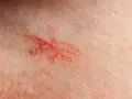Widoczne popękane naczynka na piersiach, tworzące delikatną, czerwoną pajęczynkę na jasnej skórze.