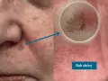 Zmiana na skórze, która wygląda jak pieprzyk na policzku, powiększona pod dermatoskopem.