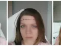 Kobieta przed zabiegiem, z zaznaczoną głową do podania botoksu na migreny, i po zabiegu.