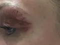 Widoczna opuchlizna po operacji powiek z widocznymi śladami zabiegu. Skóra wokół oka jest zaczerwieniona i lekko podrażniona.