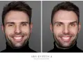 Porównanie efektów zabiegu: po lewej widoczne zmarszczki wokół oczu, po prawej wygładzona skóra. To pokazuje, jak działa botox dzień po dniu.