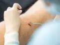 Chirurg zszywa ranę po usunięciu pieprzyka na nodze. Widoczna jest blizna i narzędzia chirurgiczne.