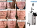 Postępy po zabiegu laserem CO2: od zaczerwienienia do wygojenia skóry w ciągu 7 dni. Obok urządzenie do laseroterapii.