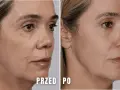 Przed i po zabiegu juvelook pod oczy. Skóra wokół oczu wygładzona, zmarszczki zredukowane.