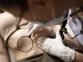 Lekarz w rękawiczkach bada pieprzyki na brzuchu pacjentki za pomocą lupy, przygotowując się do laserowego usuwania pieprzyków.