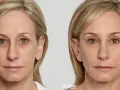 Przed i po: wygładzone zmarszczki wokół oczu, odmłodzony wygląd. Efekt zabiegu na ami eyes.