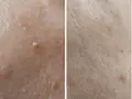Zbliżenie na skórę z widocznymi drobnymi zmianami, w tym jedną większą, która może być brodawką pod pachą.