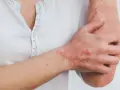 Ręka i przedramię z widocznymi, czerwonymi, swędzącymi zmianami skórnymi, które mogą wskazywać na łuszczycę lub inne schorzenia dermatologiczne.