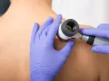 Dermatolog bada dużą ilość pieprzyków na plecach pacjenta za pomocą dermatoskopu.