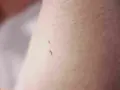 Dwa małe, cieliste włókniaki na skórze. Pytanie, czy włókniaki są zaraźliwe, nurtuje wiele osób.