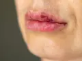 Siniaki na twarzy po zabiegu? Zobacz, jaki jest sposób na siniaki na twarzy po zabiegu, aby szybko wrócić do formy.