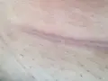 Widoczna blizna na szyi po operacji, lekko różowa, z drobnymi włoskami na skórze.