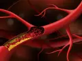 Przekrój naczynia krwionośnego z żółtymi złogami cholesterolu, które powodują, że naczynia krwionośne obkurczają się, utrudniając przepływ krwi.