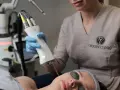 Zabieg laserem Fotona R35NX w Origin Clinic. Widoczna głowica lasera i pacjentka w okularach ochronnych. Oczekiwane spektakularne efekty odmładzające.