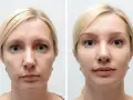 Joga twarzy przed i po: widoczne wygładzenie zmarszczek i poprawa napięcia skóry.