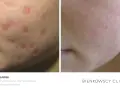 Przed i po laserze frakcyjnym: widoczna poprawa po terapii blizn, zredukowany wysyp pryszczy.