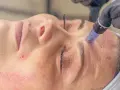 Zabieg dermapen w domu: mikroigłowanie skóry twarzy, widoczne zaczerwienienia i drobne nakłucia.