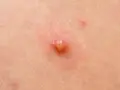 Pęcherzyk z płynem, przypominający kaszak pod skórą, otoczony zaczerwienieniem.