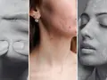 Trzy panele pokazujące problemy skórne: wyciskanie pryszcza, trądzik na twarzy i szyi, oraz pielęgnacja skóry. Dermatologia i wenerologia w praktyce.