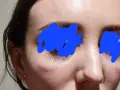 Widoczna opuchlizna po laserze frakcyjnym pod oczami i na policzkach. Skóra jest lekko zaczerwieniona i błyszcząca.