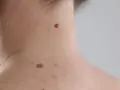Na skórze szyi widoczne są liczne pieprzyki i jedno ciemniejsze znamię.