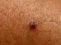 Zbliżenie na pieprzyk z włoskami. Czy pieprzyki rosną? Ten wygląda na aktywny, z kilkoma włoskami wyrastającymi z niego.