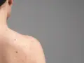 Widoczne zaczerwienienia i wypryski na skórze, sugerujące trądzik różowaty na plecach.