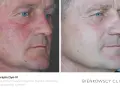 Przed i po zabiegu zamykania naczynek laserem. Skóra twarzy zaczerwieniona, z widocznymi naczynkami, po zabiegu gładka. Szybka rekonwalescencja.
