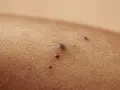 Zbliżenie na skórę z kilkoma ciemnymi znamionami. Jedno z nich, większe, przypomina czerniak - czarna kropka pod skórą.