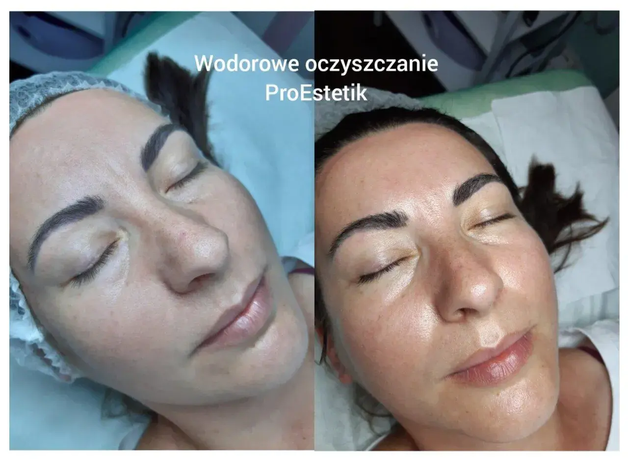 Przed i po zabiegu oczyszczania wodorowego. Skóra po zabiegu jest promienna i nawilżona.