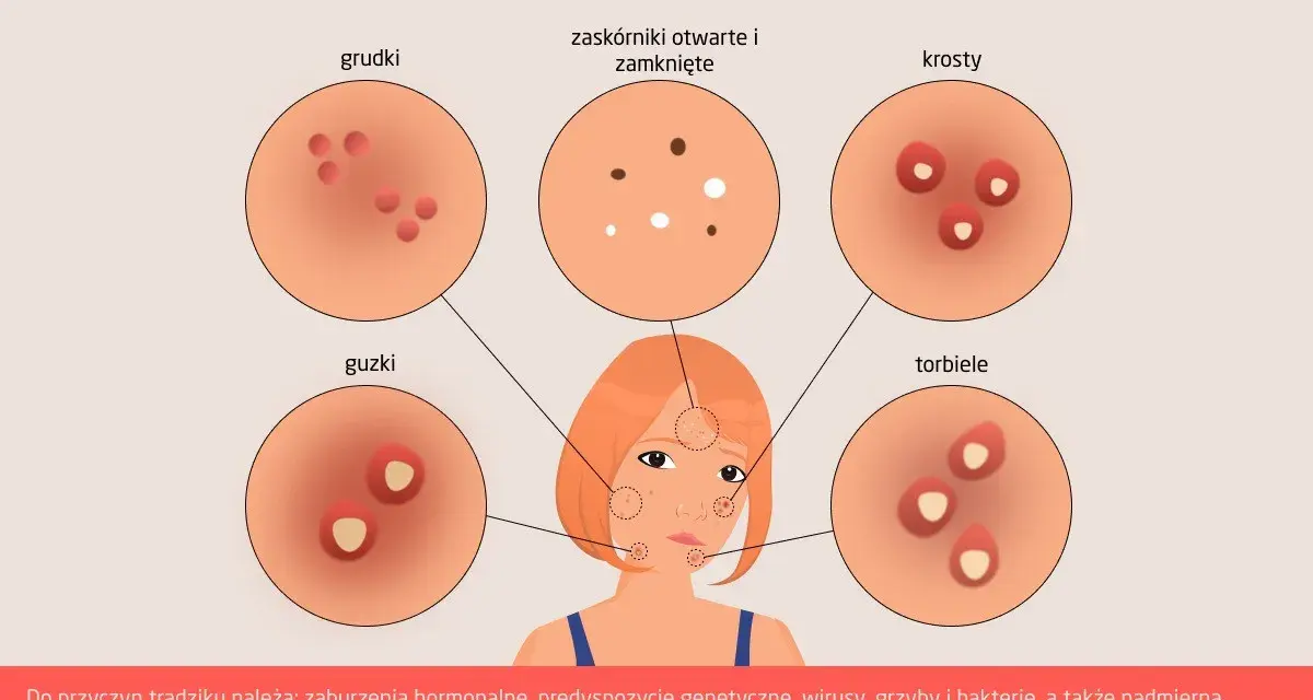 Ilustracja przedstawia różne rodzaje trądziku na skórze: grudki, zaskórniki, krosty, guzki i torbiele.