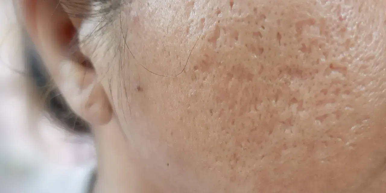 Widok z bliska na skórę twarzy z licznymi bliznami potrądzikowymi, widoczna dziura po pryszczu i pojedyncze włoski.