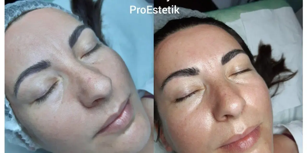 Przed i po zabiegu oczyszczania wodorowego. Skóra po zabiegu jest promienna i nawilżona.