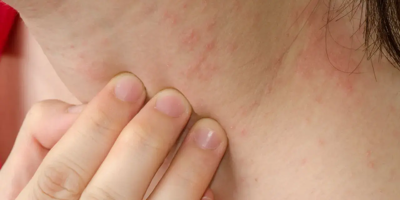Delikatne plamy wątrobowe na szyi, widoczne pod palcami, sugerują potrzebę konsultacji dermatologicznej.