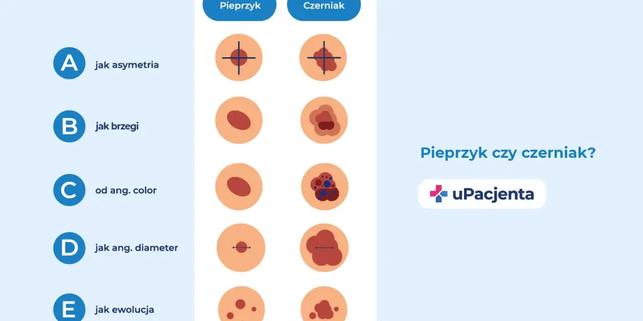 Porównanie pieprzyka i czerniaka: asymetria, brzegi, kolor, średnica i ewolucja. Jak wygląda czerniak skóry?