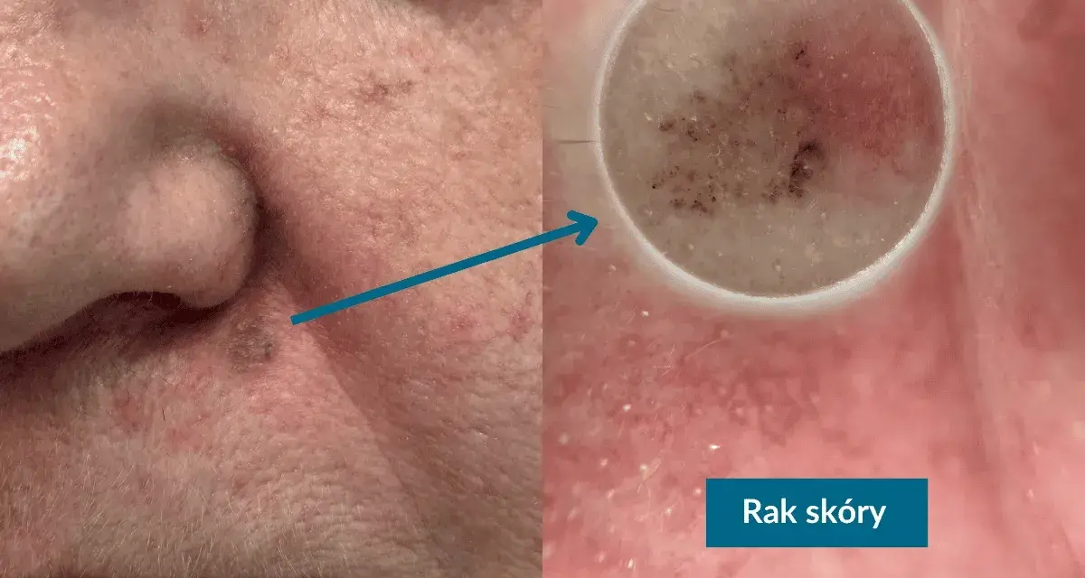 Zmiana na skórze, która wygląda jak pieprzyk na policzku, powiększona pod dermatoskopem.