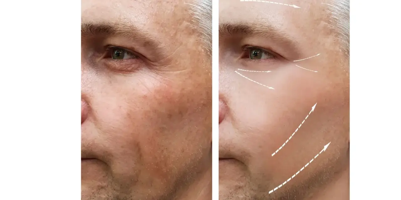 Przed i po zabiegu: wygładzenie zmarszczek na czole i policzkach dzięki botoksowi w żwacze. Strzałki wskazują kierunek liftingu.