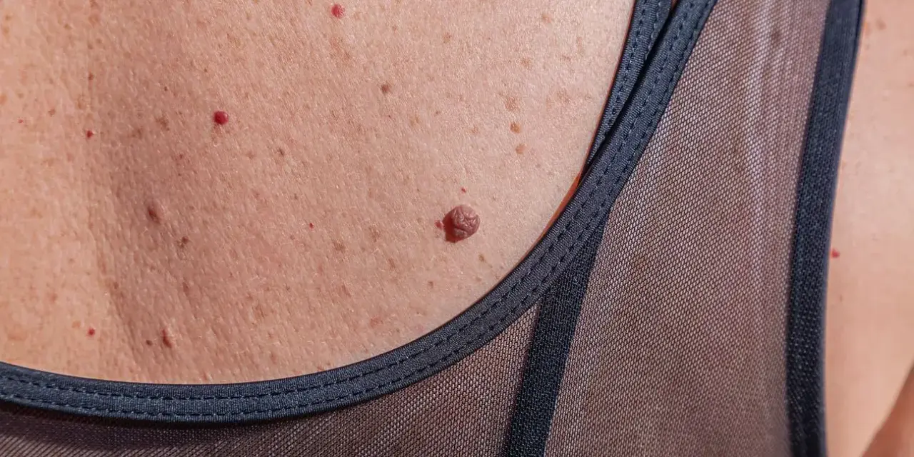 Skóra z piegami, brodawkami i kilkoma punkcikami rubinowymi. Czy te punkty rubinowe a tarczyca mają związek?