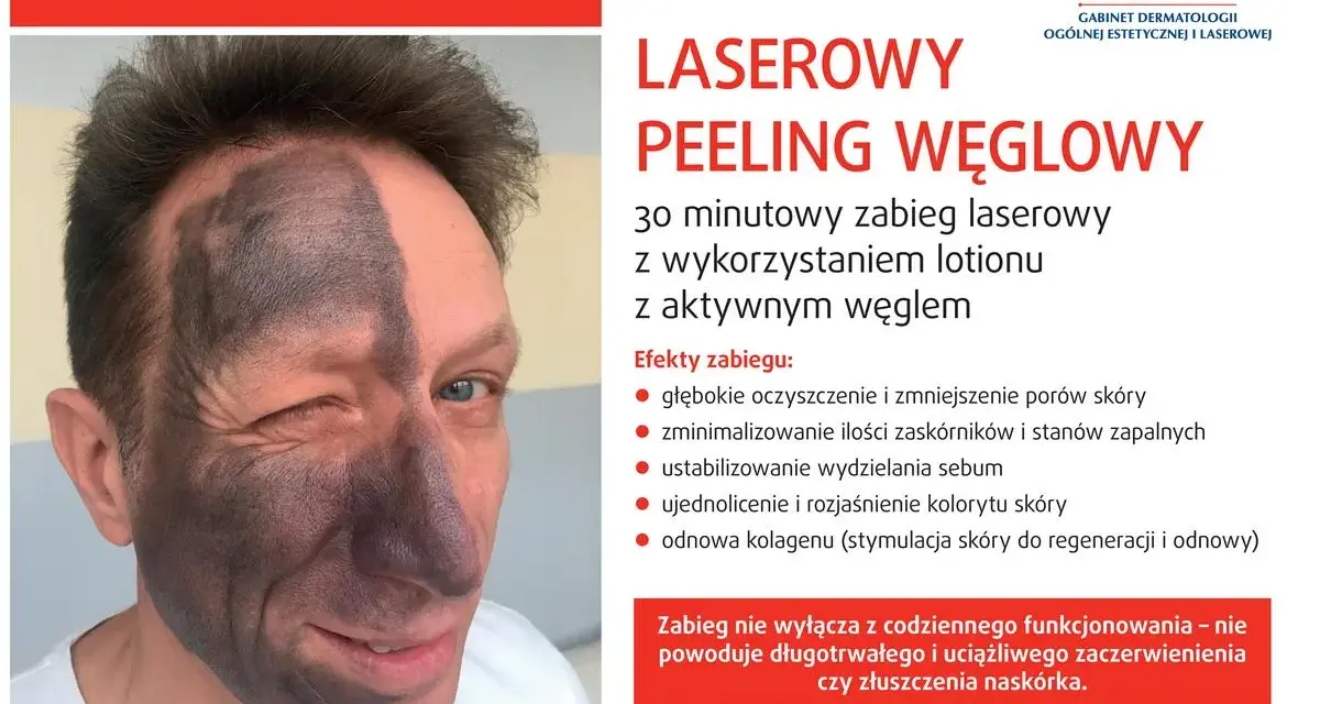 Przed i po laserowym peelingu węglowym: połowa twarzy pokryta czarną maską węglową, druga połowa czysta. Efekt odświeżenia i oczyszczenia.