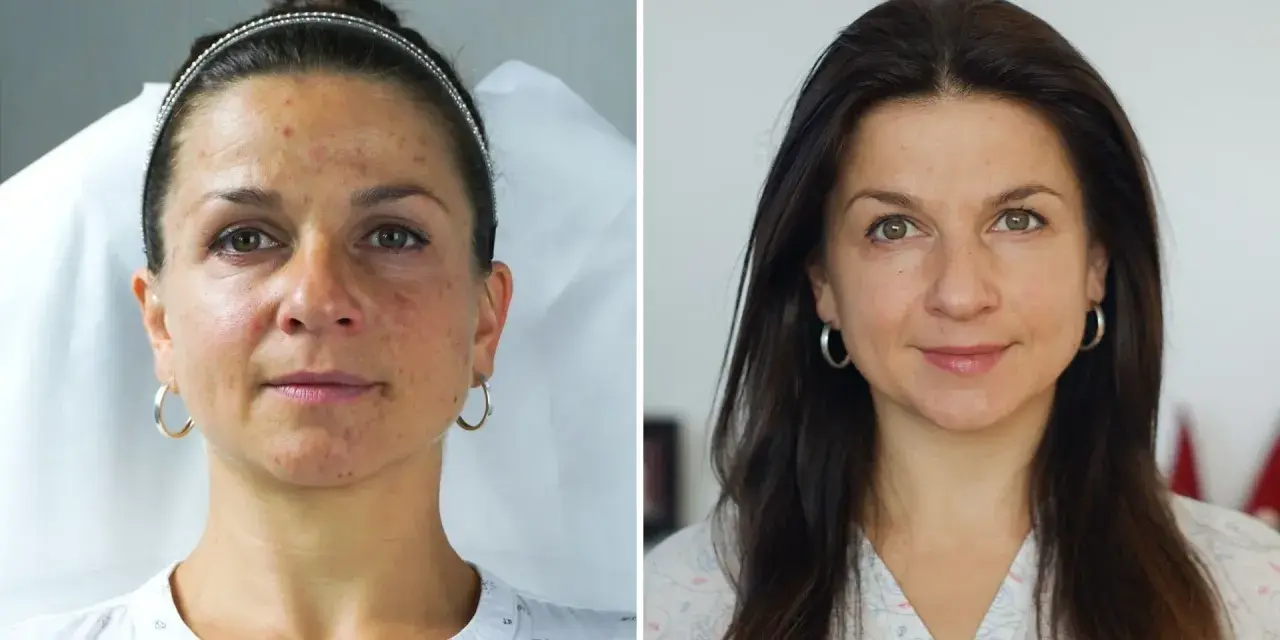 Przed i po zabiegu: skóra z niedoskonałościami i przebarwieniami staje się gładka i promienna. Fibryna pod oczy zdziałała cuda!