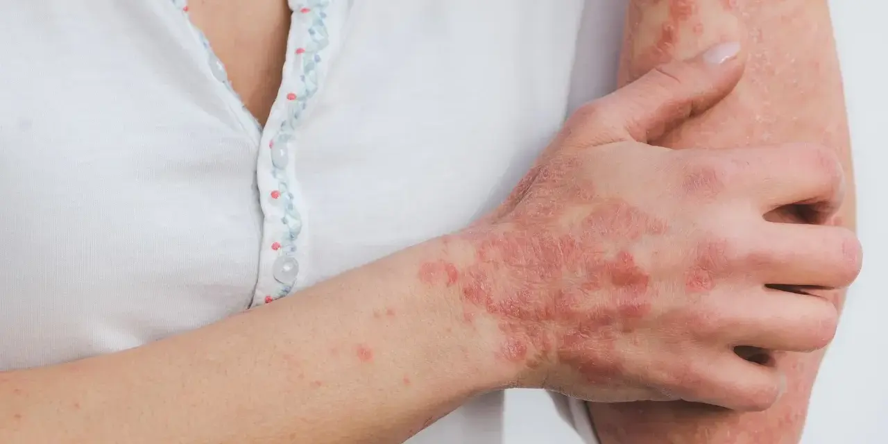 Ręka i przedramię z widocznymi, czerwonymi, swędzącymi zmianami skórnymi, które mogą wskazywać na łuszczycę lub inne schorzenia dermatologiczne.