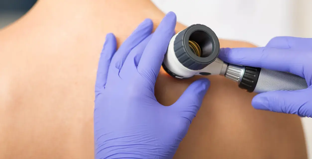 Dermatolog bada dużą ilość pieprzyków na plecach pacjenta za pomocą dermatoskopu.