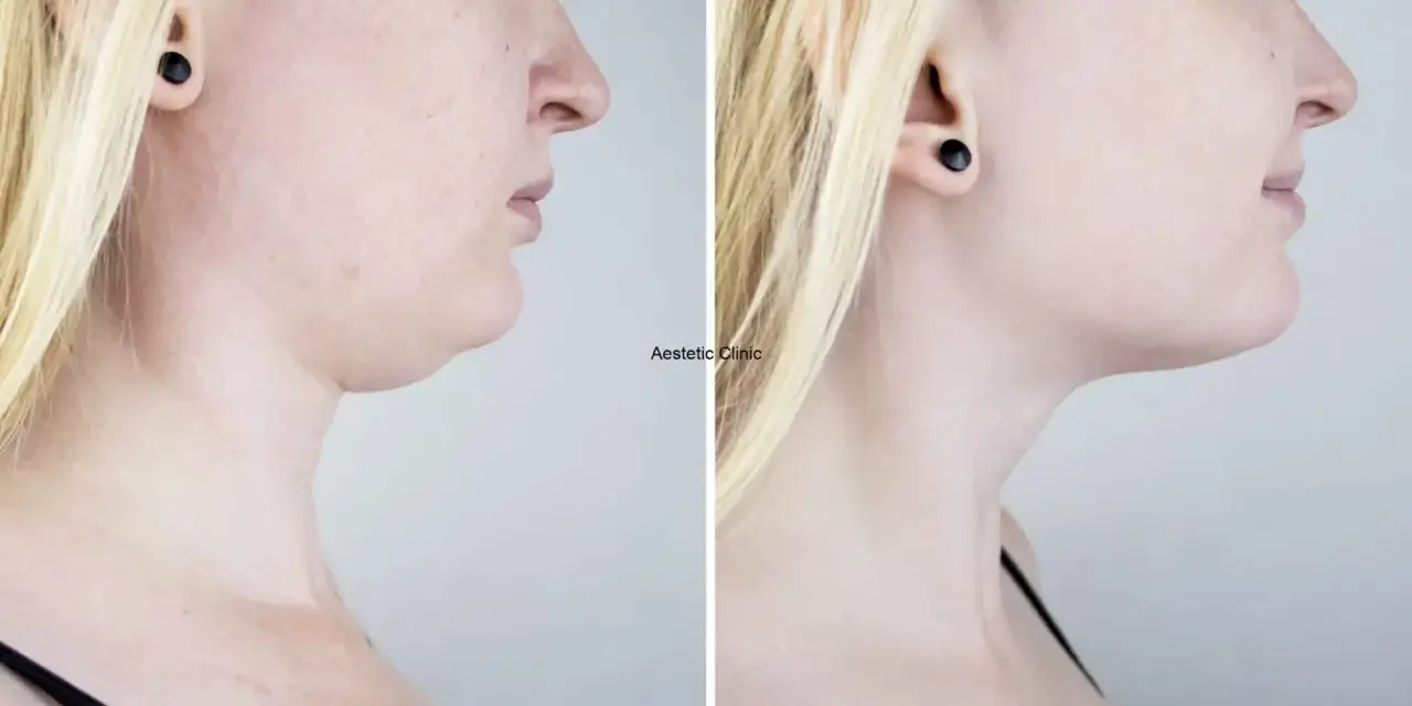 Przed i po zabiegu: widoczna redukcja podwójnego podbródka dzięki lipolizie. Efekty lipolizy podbródka są spektakularne.