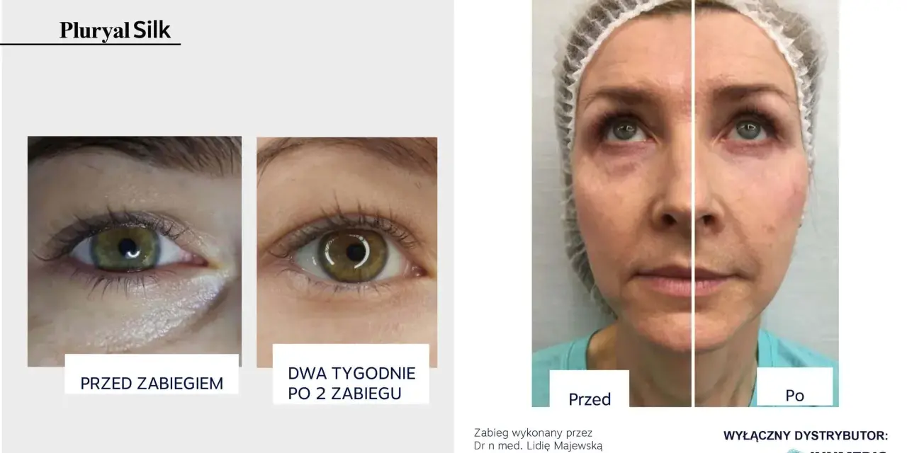 Pluryal Silk efekty: porównanie okolic oczu przed i po zabiegu, a także twarzy przed i po. Widać wygładzenie skóry.