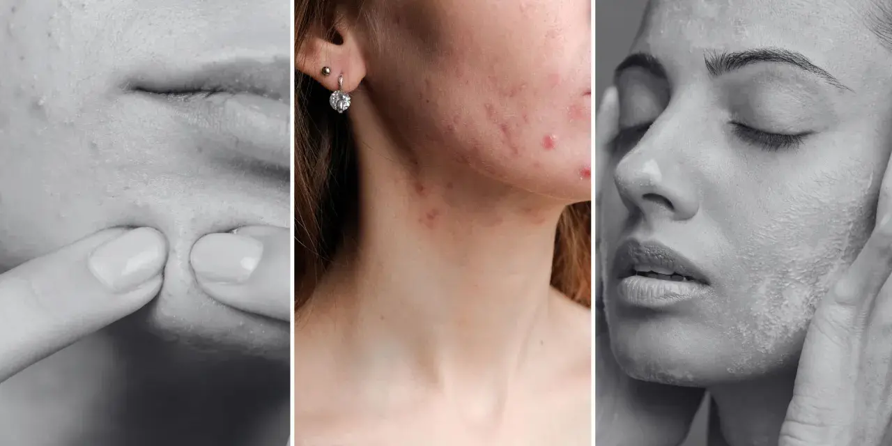 Trzy panele pokazujące problemy skórne: wyciskanie pryszcza, trądzik na twarzy i szyi, oraz pielęgnacja skóry. Dermatologia i wenerologia w praktyce.