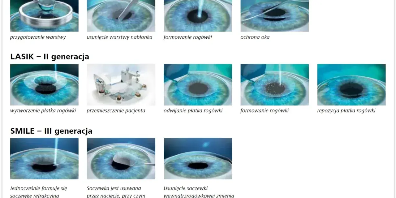 Ilustracje pokazują metody korekcji wzroku laserem: PRK, LASIK, SMILE. Nie ma tu informacji o laserze na kręgosłup lędźwiowy przeciwwskazania.