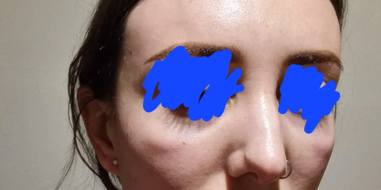 Widoczna opuchlizna po laserze frakcyjnym pod oczami i na policzkach. Skóra jest lekko zaczerwieniona i błyszcząca.